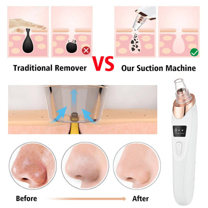 5 in 1 Electric Blackhead Remover vacuum, WhiteHead, blackhead & Acne cleaner